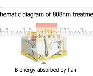 Hot Selling TEC Cooling System Stationary 808nm Diode Laser Hair Removal Depilador Laser Epila thumbnail-4