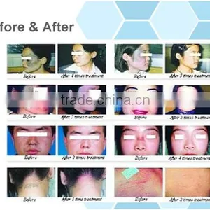 Best Effective CO2 Laser/fractional CO2 Laser/CO2 Fractional Laser/co2 Laser Scar Remover thumbnail-6
