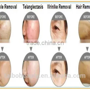 Vascular Treatment 2016 Ipl Shr Hair Removal Machine / Ipl Shr Made In China / Ipl Machine Multifunctional Facial Spa Machine Lips Hair Removal thumbnail-6
