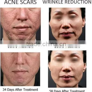 Hot Sale Radiofrequency Fractional RF Microneedle Laser Facial Rejuvenation Machine thumbnail-2