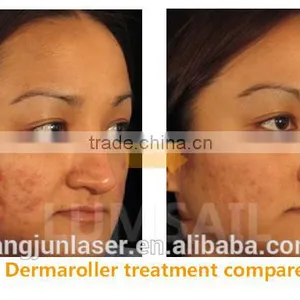 Factory Price 540 Micro Needle Zgts Derma Roller for Skin Therapy thumbnail-4