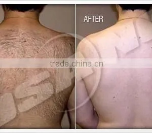 Germany Bars 808nm Diode Laser For Hair Removal Laser thumbnail-6