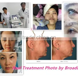 Non-invasive Facial Lifting 13mm for Body Thinner Hifu Vaginal Tighten thumbnail-5