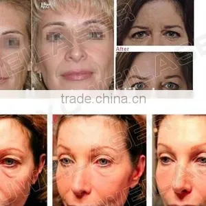 4MHZ High Quality Hifu Facelift / Professional Face Lift Hifu Machine Facial Lifting Multi-polar RF thumbnail-4