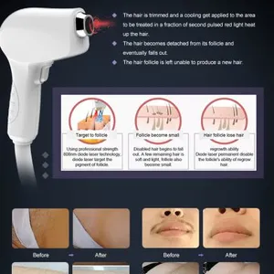 Diode Laser 808 nm Hair Removal Machine Portable 808 nm Diode Laser Epilator Clinic Use Permanent Laser Hair Removal Machine thumbnail-5