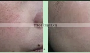 China Hair Salon Equipment Vascular Spider Vein Removal Machine thumbnail-4