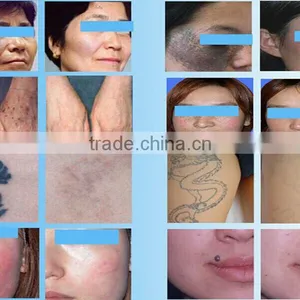 Sanhe SQ-2 Nd: Yag Laser Skin Care System/ 10.4 Inch Color Touch Tattoo Removal Machine thumbnail-5