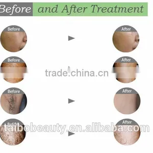 Distributors for Ireland Permanent Hair Remove Machine / Ipl Alex Laser Shr Hair Removal thumbnail-4
