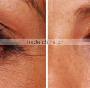 2015 rf Eyes Care Salon Portable Machine thumbnail-5