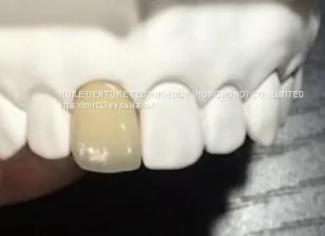 Dental Pfm Crown From China Dental Lab thumbnail-3