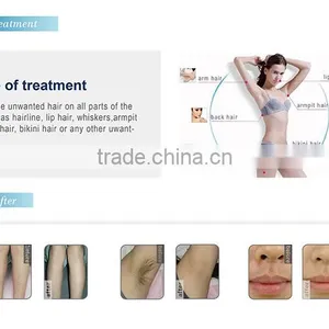 Best Painless and Permanent Depilator Professional 808 Diode Laser Hair Removal Machine thumbnail-4