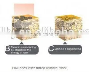 Portable Tattoo Removal Machine thumbnail-2