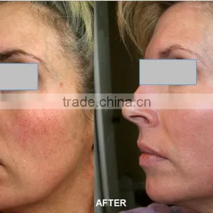 Beautician Use Nd Yag Laser Tattoo Removal Laser for Sale thumbnail-6