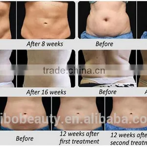 Cryotherapy Cryo Cool Tech Fat Freezing Body Sculpting Cryolipolisis 2016 Slimming Machines thumbnail-6