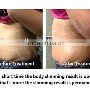 Liposuction Equipment Cosmetic Surgery Liposuction Equipment High Quality Plastic Surgery Equipment thumbnail-5
