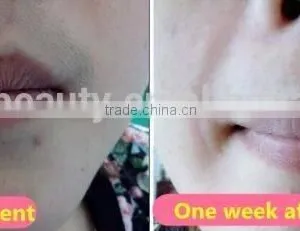 Mona SH-960 Ipl Hair Removal Machine(ipl+shr+elight) thumbnail-5