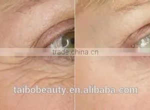 Fractional rf Micro Needling Dark Spot Removal Machine From Beauty Salon Equipment Supplier thumbnail-3