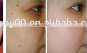 Benign Familial Pemphigus Treatment Laser Machine/co2 Laser Machine for Surgical thumbnail-4