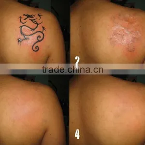 Varicose Veins Treatment Promotion!!!!ND:YAG Tattoo Removal 1 HZ Laser Machine For Beauty & Personnal Care Tattoo Removal Laser Machine thumbnail-6