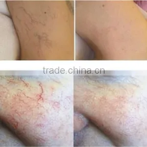 Laser Beauty Equipment SDL-G Model 980nm Diode Laser Vascular Removal thumbnail-6