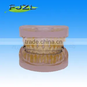 Orthodontic Teeth Model(Transparent Model , Dislocation Tooth, Common Brackets),dental Orthodontic Models thumbnail-1