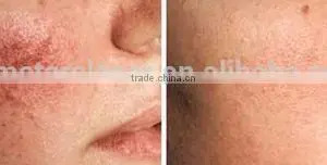 Hot Sale New Year Spider Veins/ Spider Vein Laser/ Spider Vein Removal Machine thumbnail-5