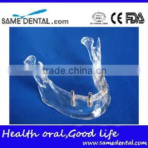 Hot Sale Transparant Mandibule Implant Model thumbnail-2