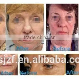 Anybeauty With 7 Treatment Heads Portable HIFU-C Hifu Ultra Face Lift thumbnail-5