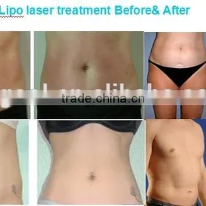 2016 Hot in USA Newest Lipo Laser 14 Pads 650nm 940nm Lipo Laser Slimming Machine for Sale / Laser Slimming Lipo Price thumbnail-6