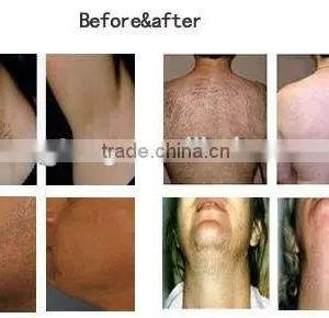 Hot Sale Acne Removal Painless Ipl Hair Removal System thumbnail-3