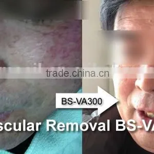 High Frequency Vascular Removal Red Spider thumbnail-4