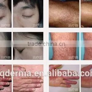 Treat Vitiligo at Home by Yoursel ! FHandheld Home Use 308nm Mini Excimer Treatment Device for Vitiligo thumbnail-1