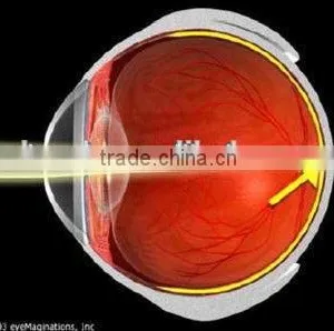 MCT-G/ High-end MCT Technology For Myopia With High Intraocular Pressure thumbnail-1
