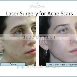 Fractional Co2 Scar Removal Laser From POP IPL thumbnail-3