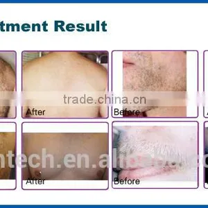CE ISO Approved Portable Medical 808nm Diode Laser Hair Removal Machine With 160J/cm3 Energy thumbnail-3