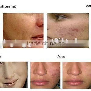 Hot Sale Acne Removal Painless Ipl Hair Removal System thumbnail-5