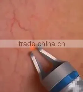 Spider Vein Removal Laser thumbnail-5