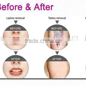 1 HZ New Professional Manufacturer Lipline Hori Naevus Removal Removal Laser Tattoo Removal Machine thumbnail-6
