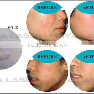 Facial Skin Care Factory Promition Diamond Peel Machine Price! Home Use Oxygen Facial Machine thumbnail-5