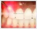 Portable Medical Dental Laser Equipment thumbnail-6