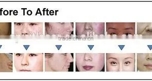 Discount Screen Logo Customized Nd Yag Laser Hair Removal Nd Yag Laser Ipl thumbnail-4
