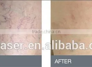 Blood Vessles Removal 980nm Red Blood Veins Removal Machine thumbnail-4