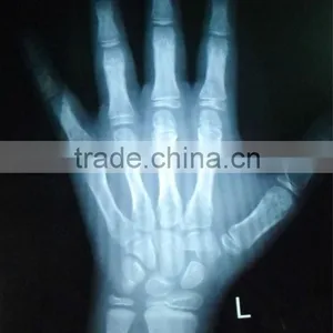 Medical Thermal X-ray Film 14x17 With CE License and ISO 13485 thumbnail-1