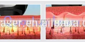 (Two Functions in One Machine) 755nm Laser Hair Removal Machine Not Only Remove Hair but Also Remove Tattoo Easily Used Clinic thumbnail-4
