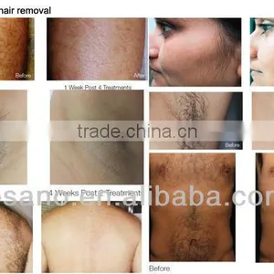 Bode 2016 808nm Diode Skin Rejuvenation Laser Hair Removal Machine thumbnail-6