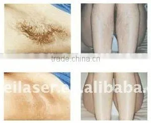 New Products Bikini Line Hair Removal Machine 808nm Diode Laser Hair Removal thumbnail-6