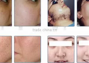 Manufacturer Laser Hair Removal Machine For Home Use thumbnail-5
