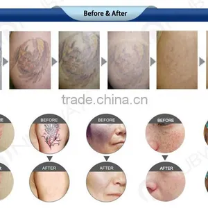 2016 Varicose Veins Laser Treatment Pigments Tattoo Removal nd Yag Laser Machine Prices thumbnail-5