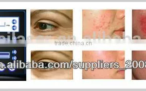 Newest Skin Rejuvenation and Wrinkle Removal Fractional rf Machine thumbnail-3