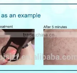 No Pain F5 Hot Sell Co2 Fractional Laser Tattoo /lip Wrinkle Removal Line Removal Used Beauty Salon Equipment For Sale 10600nm thumbnail-6